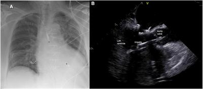 Short-term mechanical support with the Impella 5.x for mitral valve surgery in advanced heart failure—protected cardiac surgery